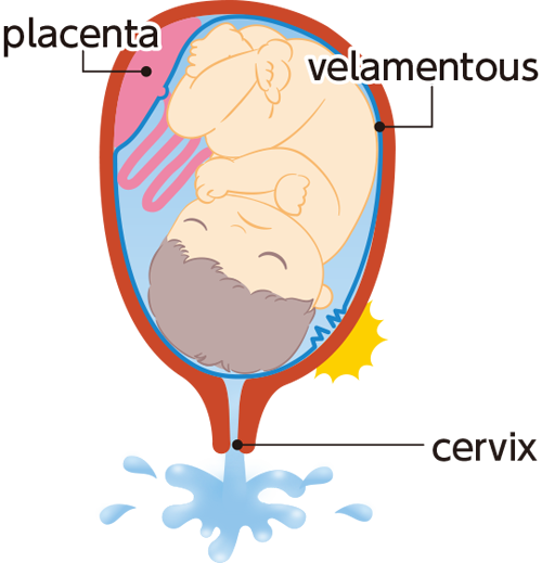 Everything you want to know about your water breaking! - Prenatal